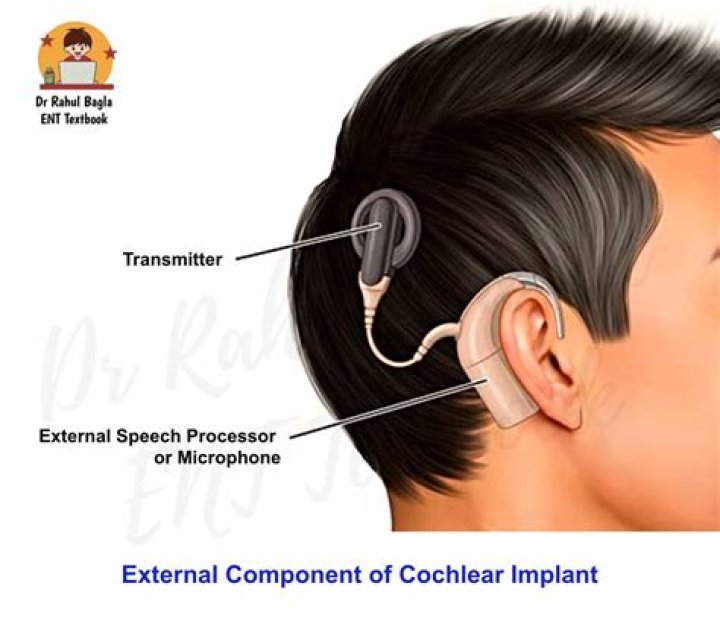 Are you awake during cochlear implant surgery?