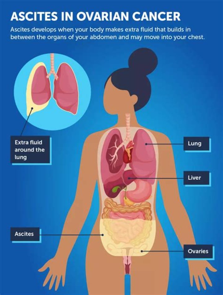 At what stage of ovarian cancer does ascites occur?