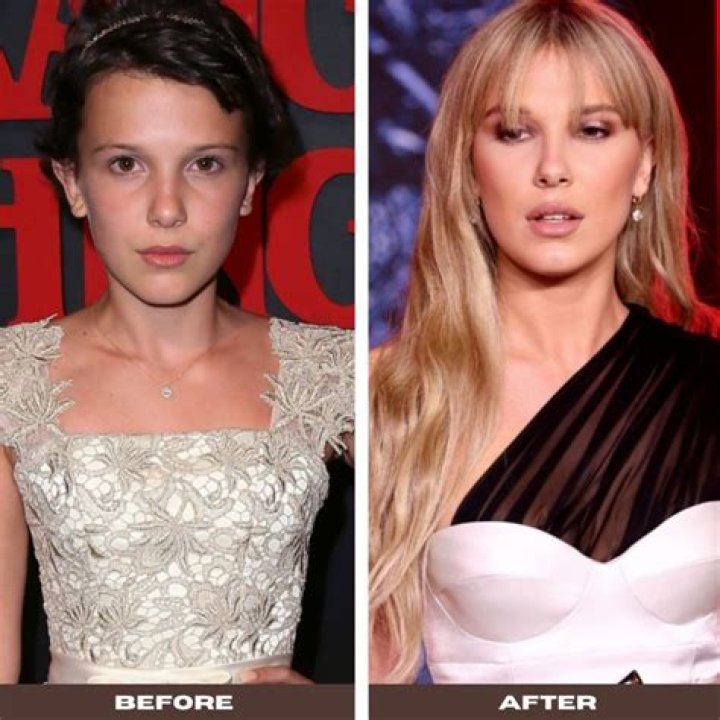 Can a 13 year old get plastic surgery?