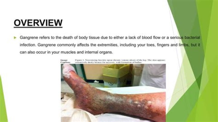 Can a gangrene be cured?