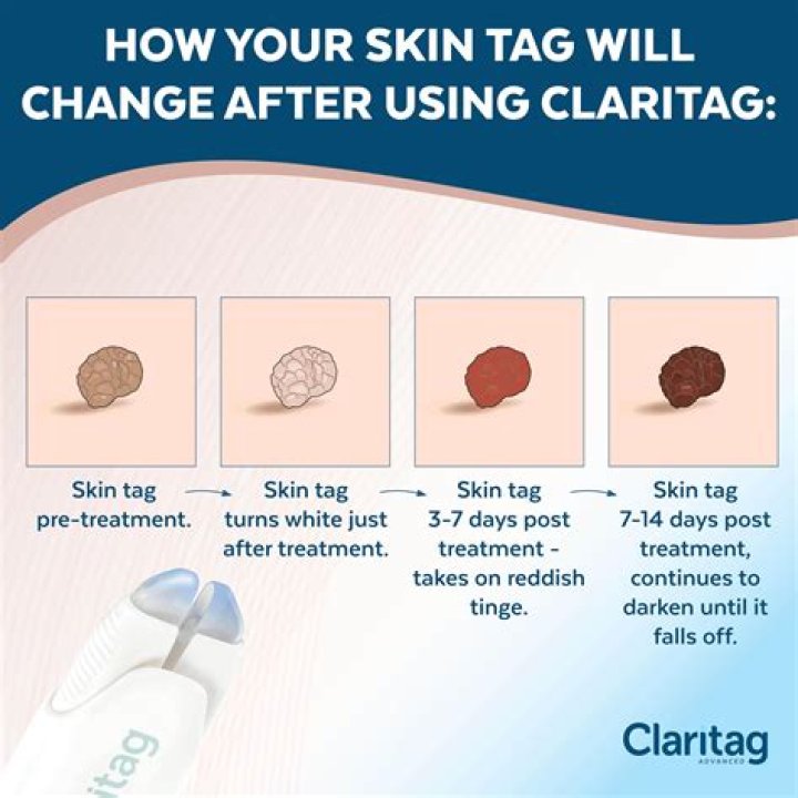 Can a GP cut off a skin tag?