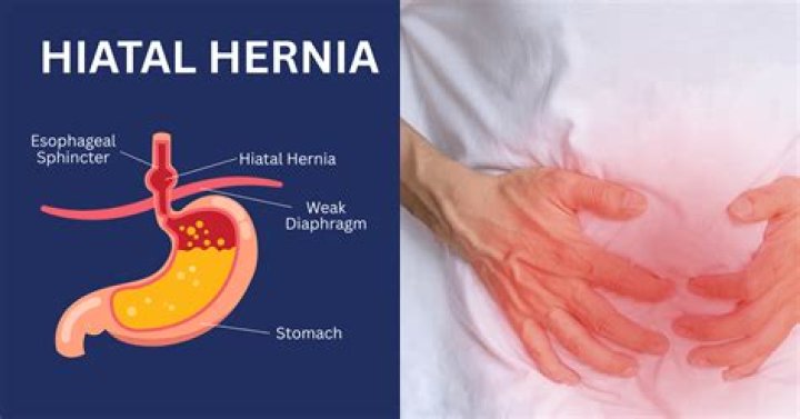 Can a hiatal hernia make you feel like your having a heart attack