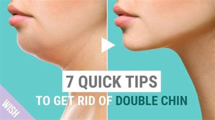 Can double chins go away?