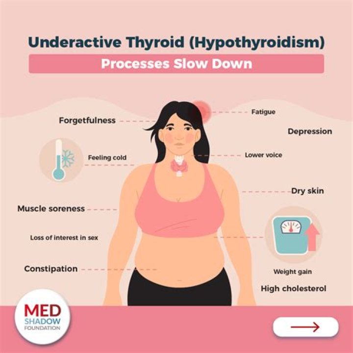 Can hypothyroidism cause Addison disease