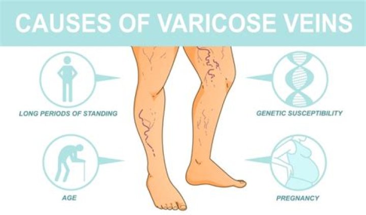 Can wrong shoes cause varicose veins?