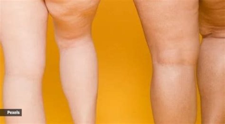 Can you actually get rid of cellulite?