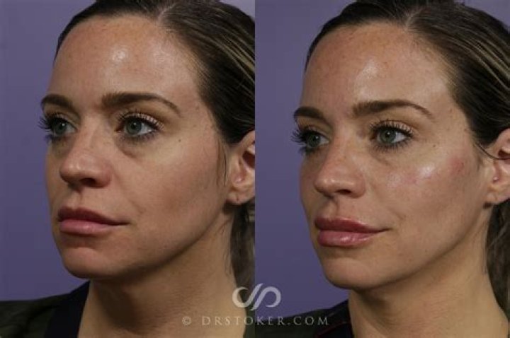 Can you do facial after fillers?