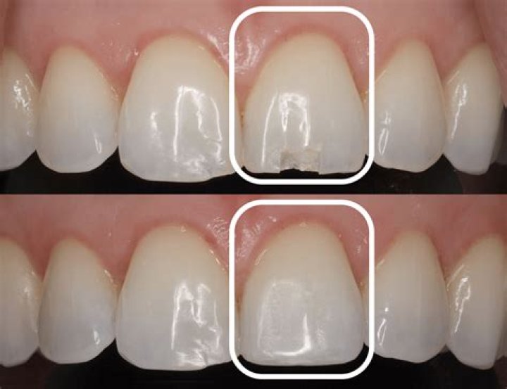 Can you fill a tooth with acrylic?