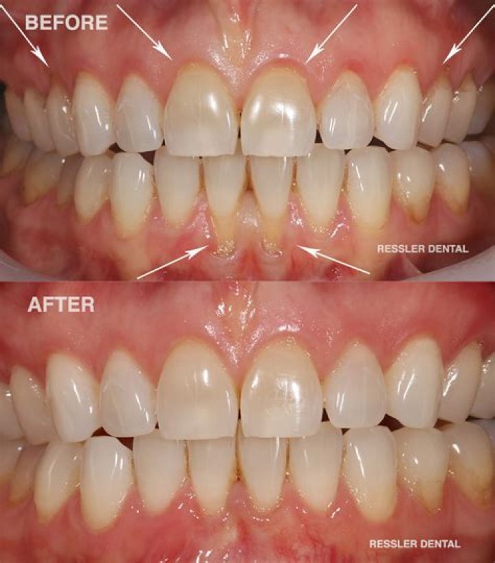 Can you fix receding gums?