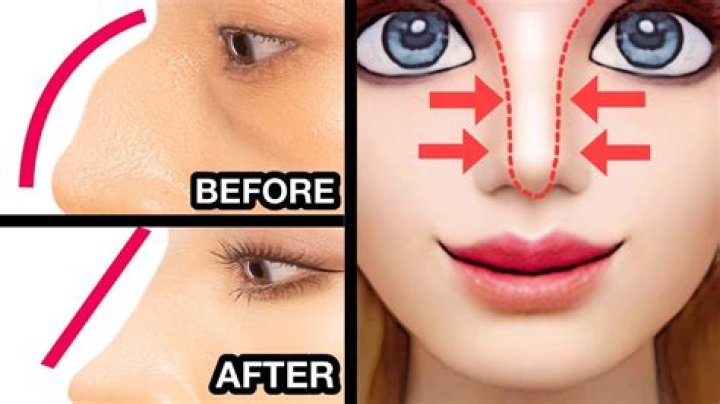 Can you get a straight nose without surgery?