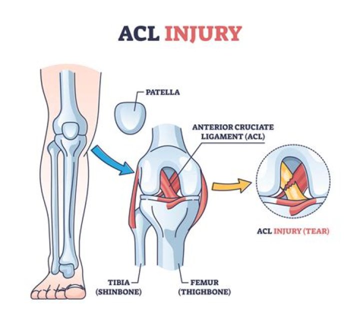 Can you tear your ACL and PCL