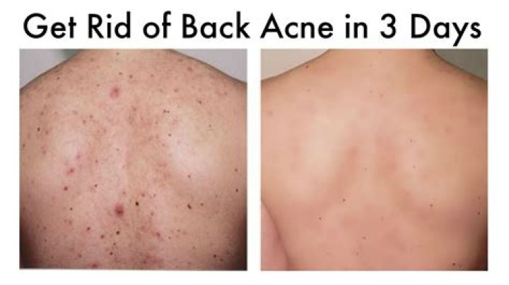Does back acne go away on its own?