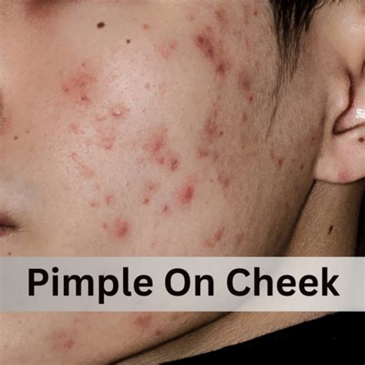 Does Proactiv work on pimples?