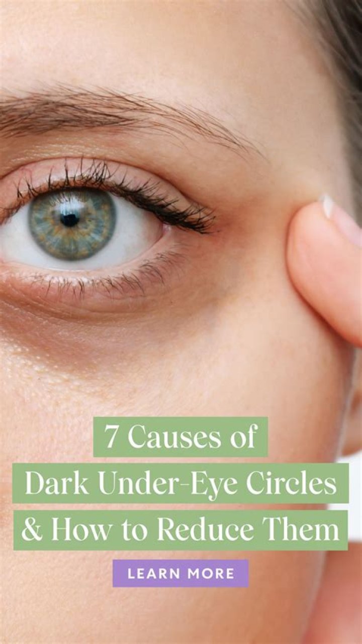 How can I get rid of dark circles under my eyes?