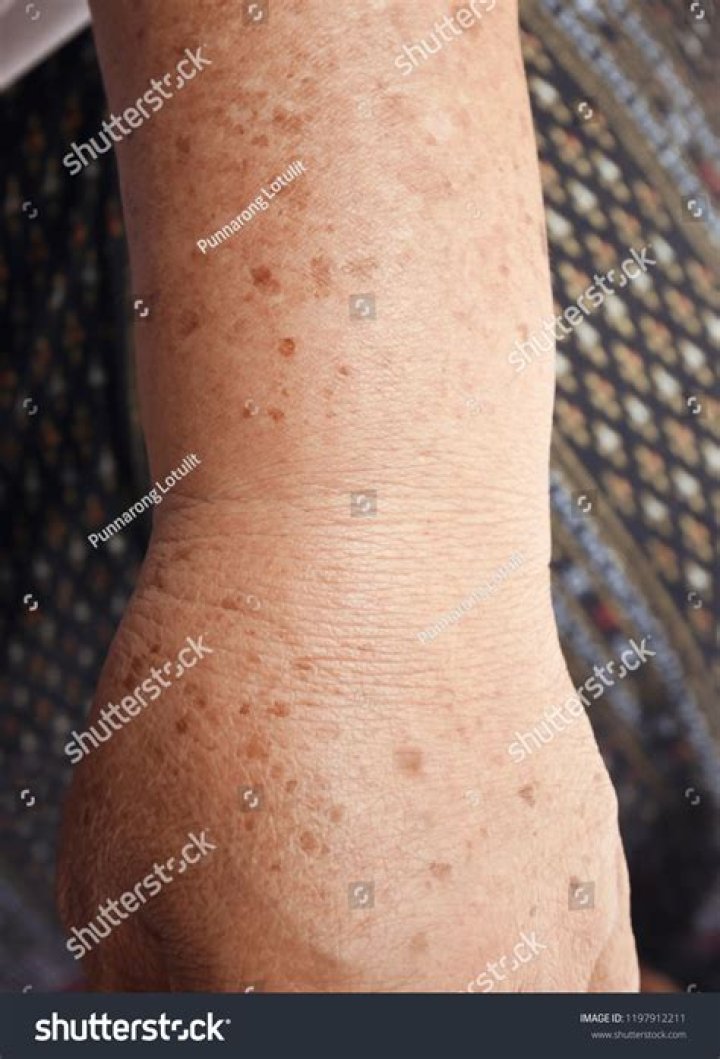 How do I get rid of age spots on my arms and hands?