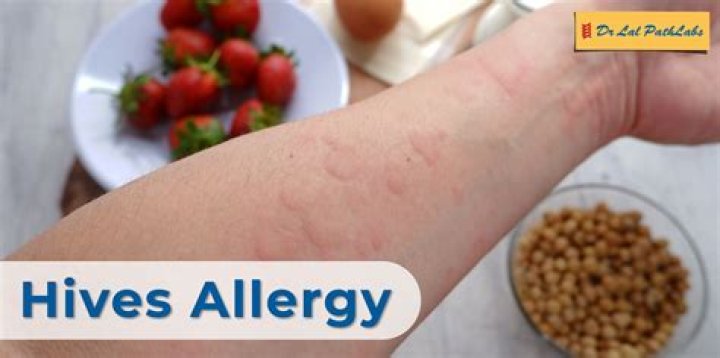 How do I know if I have hives or allergies?