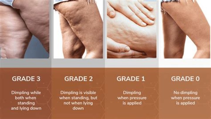 How do you break down cellulite?