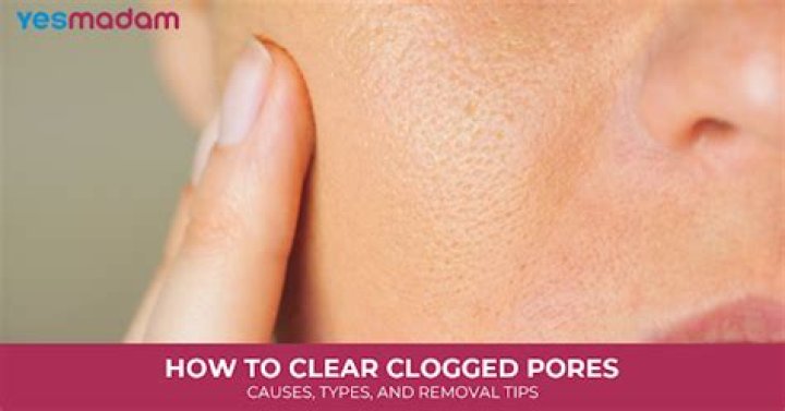How do you clear clogged pores?