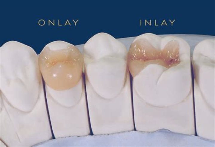 How do you define inlay restoration?