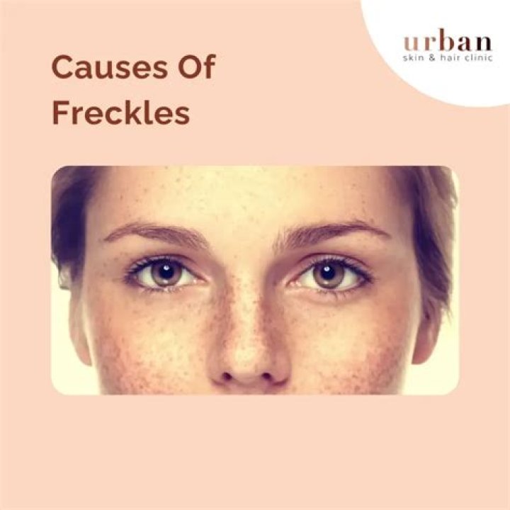 How do you get freckles?
