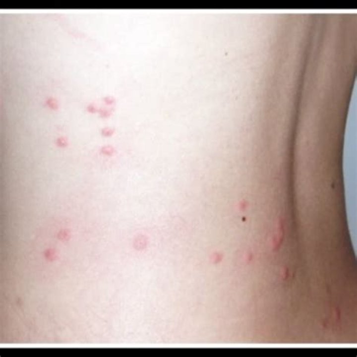 How do you get rid of dog flea bites on humans