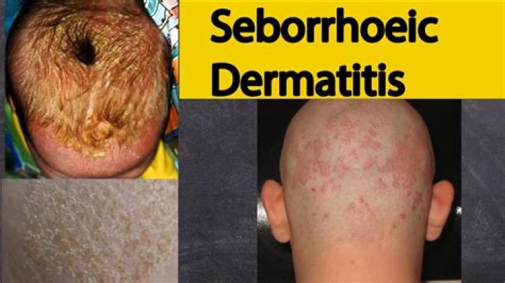How do you treat oily seborrheic dermatitis?