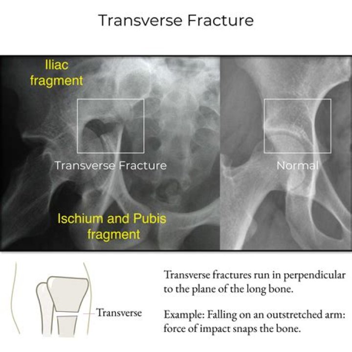 How is a transverse fracture treated
