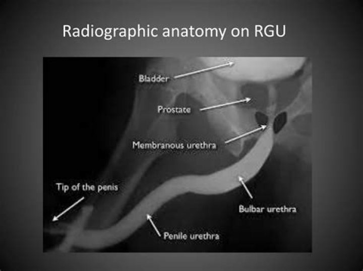 How is retrograde Urethrogram done?