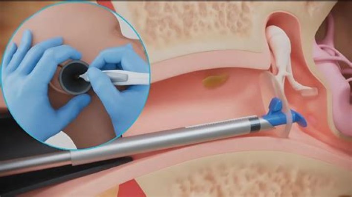 How long do ear tubes stay in toddlers?