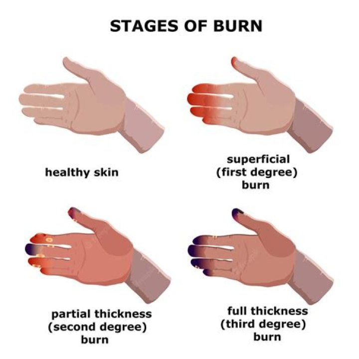 How long do eraser burns take to heal?