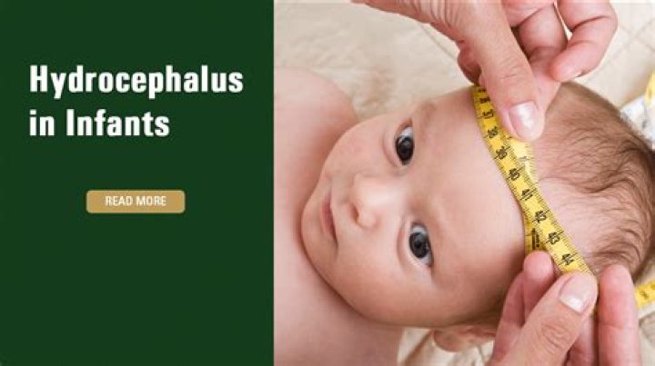 How long does a baby with hydrocephalus live?