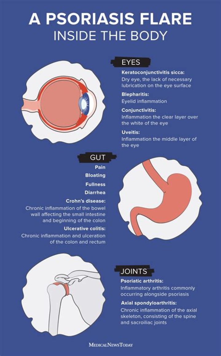 How long does cortisone flare last?