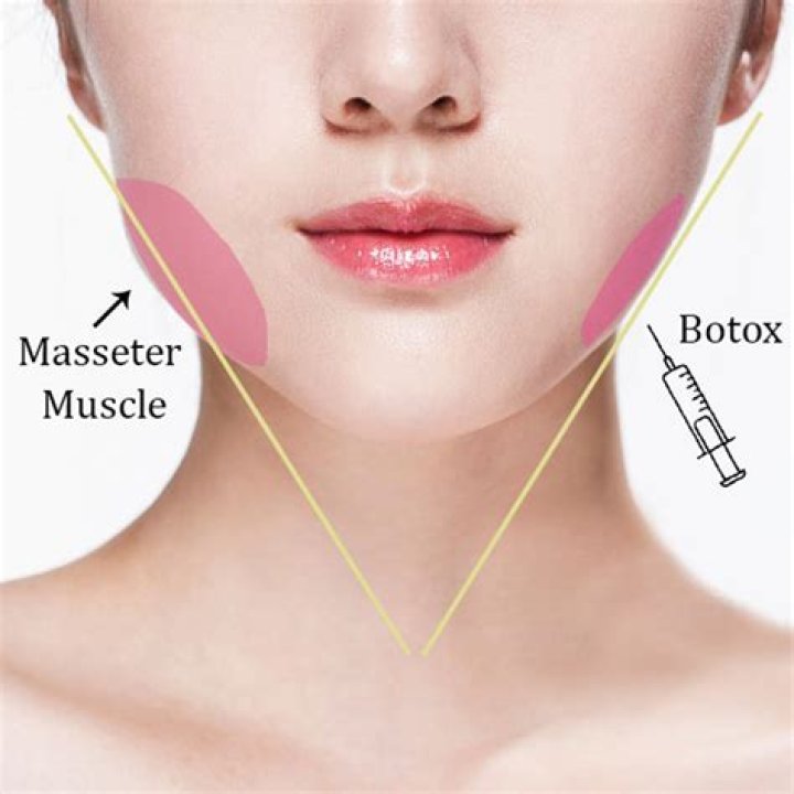 How long does masseter reduction last for?