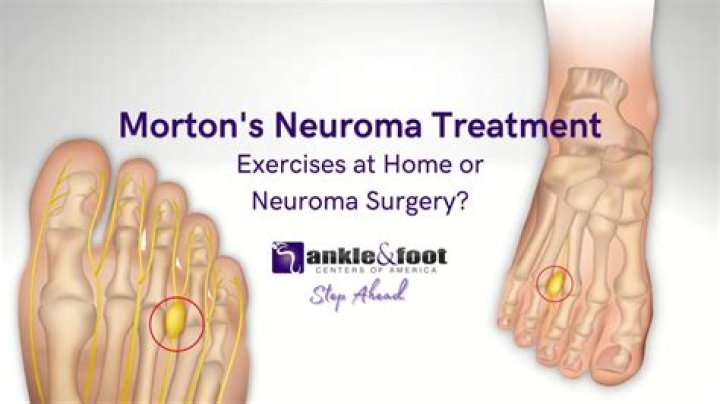How long is recovery from Mortons neuroma surgery