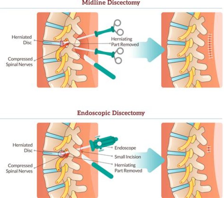 How much does a lumbar discectomy cost?