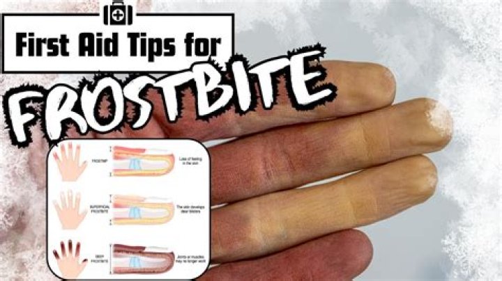 How should you care for someone with frostbite on the hands?