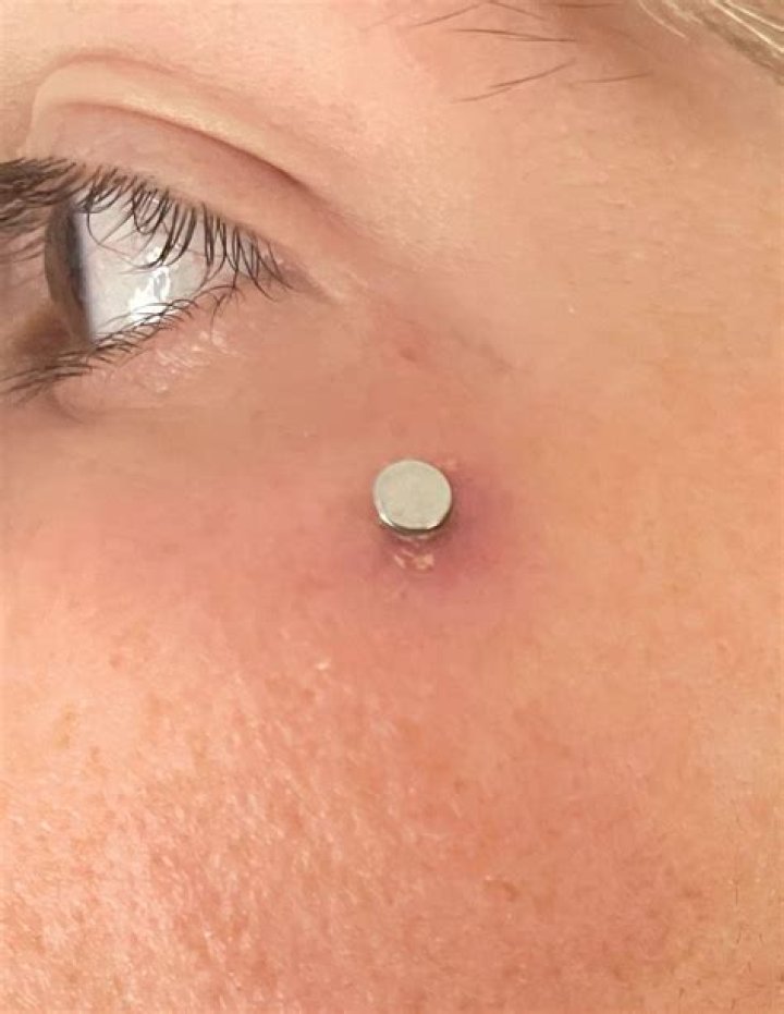 Is my dermal rejecting or infected?