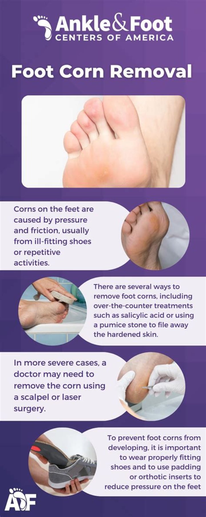 Is there any remedy to remove corn beef legs?