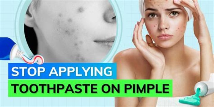 Is toothpaste good for pimple?