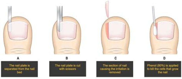 Should you pull off a detached toenail?