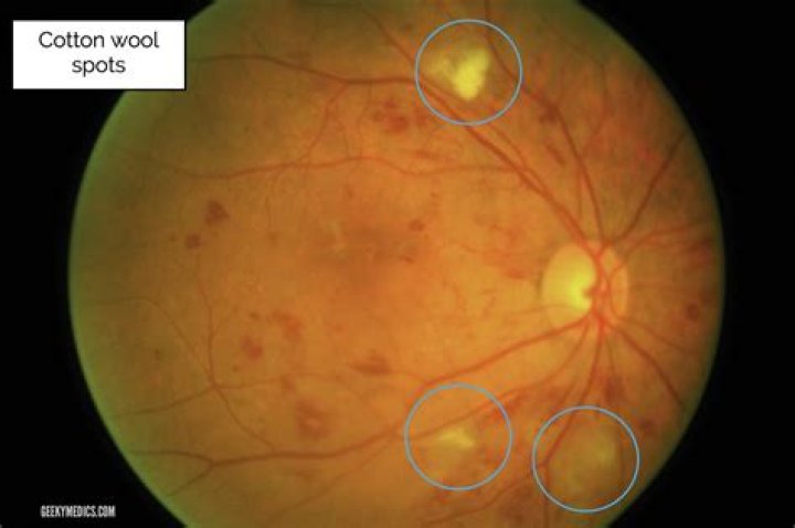 What are cotton wool spots in diabetic retinopathy?