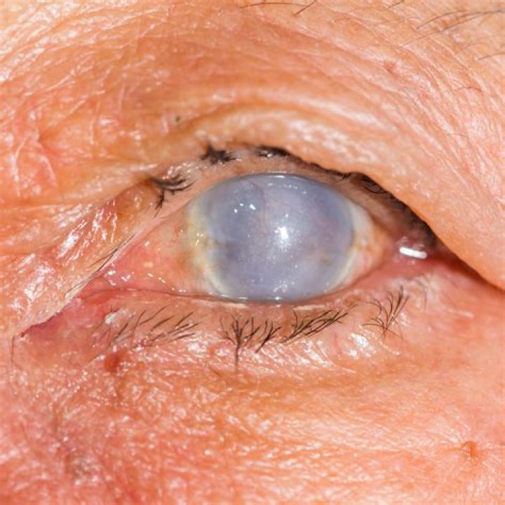 What are the causes of corneal opacities?