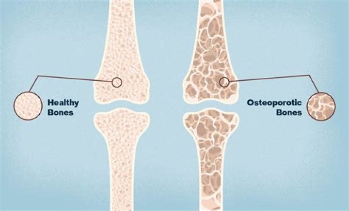 What bones are affected by osteomalacia?