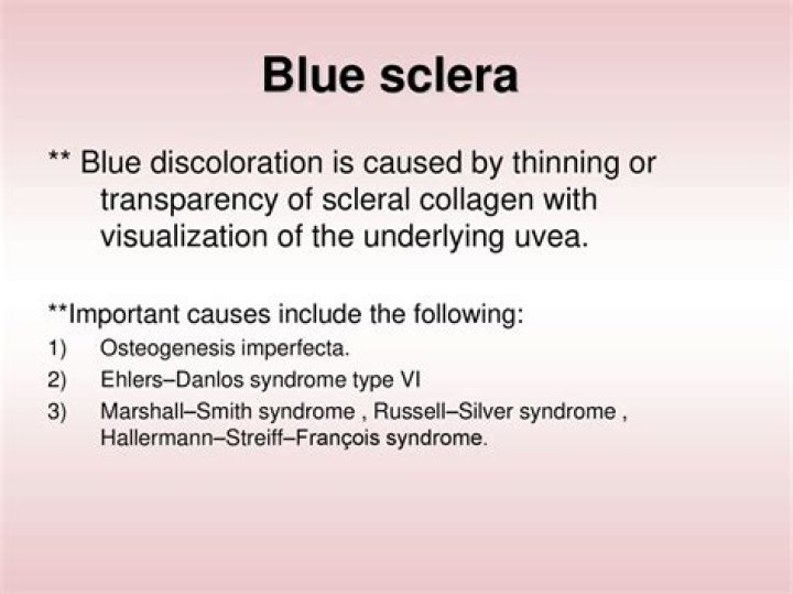What causes blue sclera in infants?