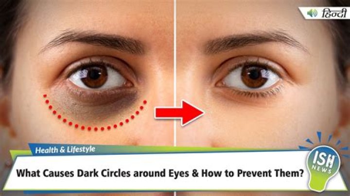 What causes darkness around eyes?