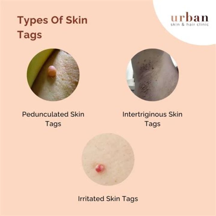 What causes skin tags under breasts?