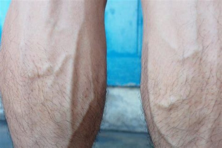 What causes veins to get bigger?
