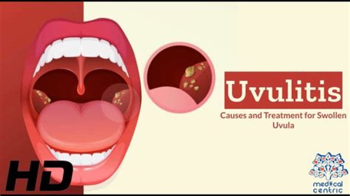 What does it mean if you dont have a uvula