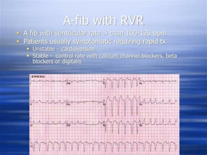What heart rate is considered RVR
