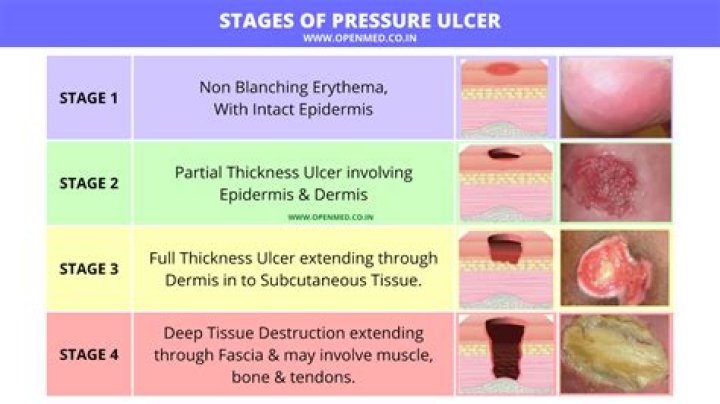 What is a Category 1 pressure ulcer